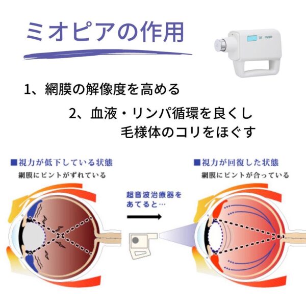 超音波治療器ミオピアの作用